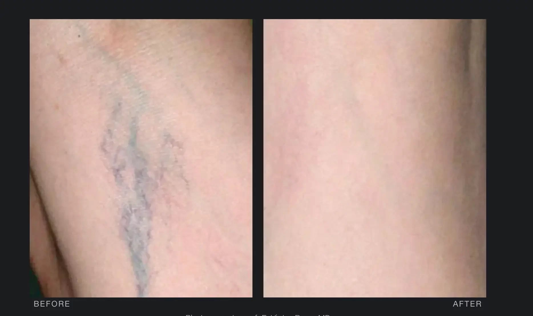 Varicose veins | before and after | Advanced Care & Medspa | Lisle, IL