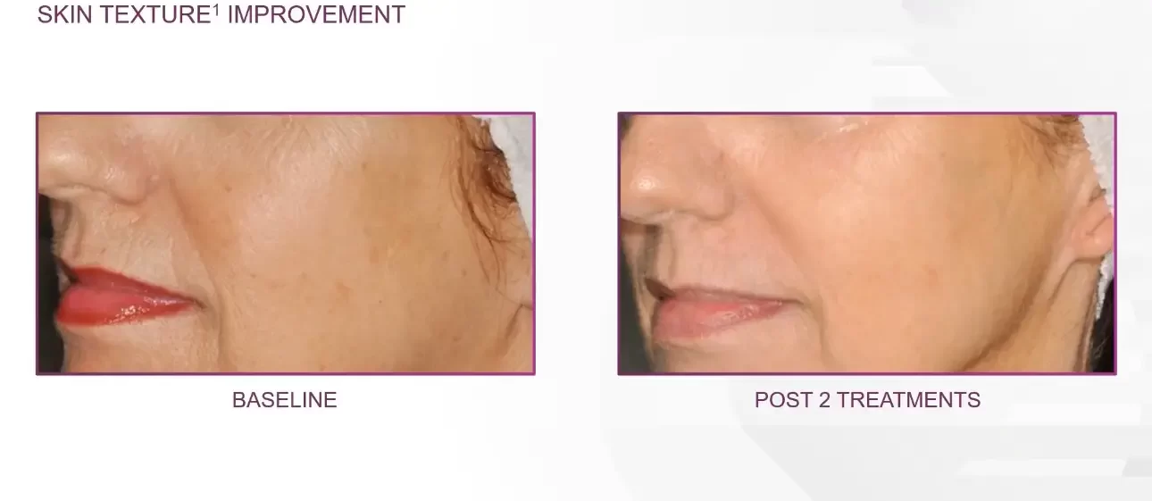 skin texture treatment2