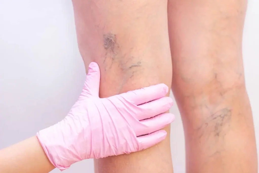Spider Vein Laser Treatment | Advanced Care & Medspa | Lisle, IL