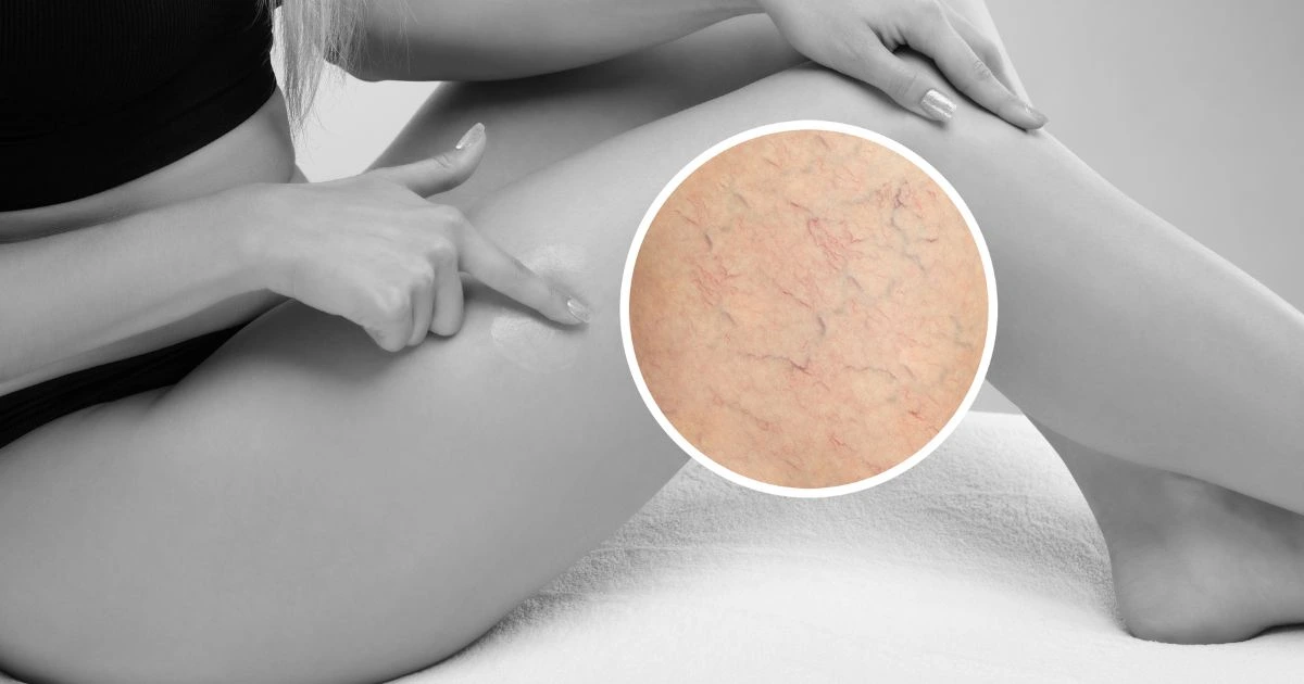 A patient receiving leg telangiectasia treatment to eliminate visible spider veins at Advanced Care & MedSpa.