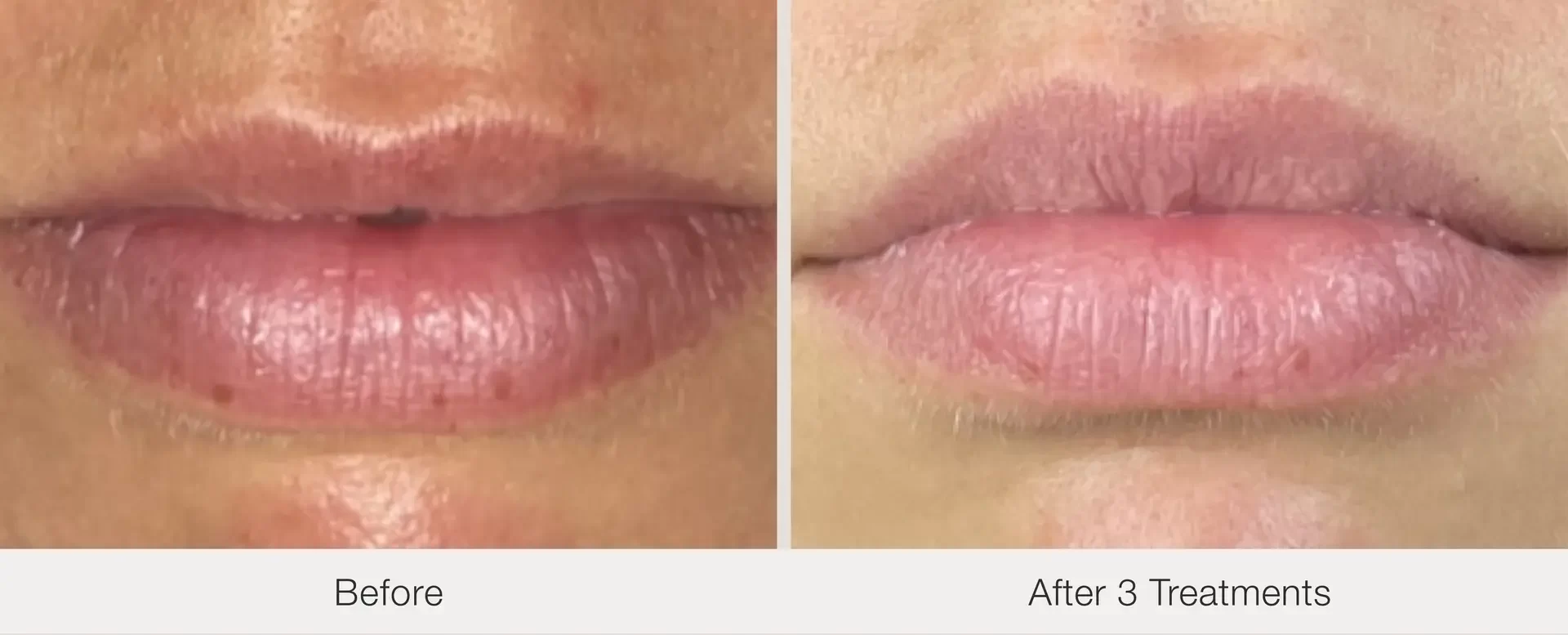 Lip lines treatment | before and after | Advanced Care & Medspa | Lisle, IL