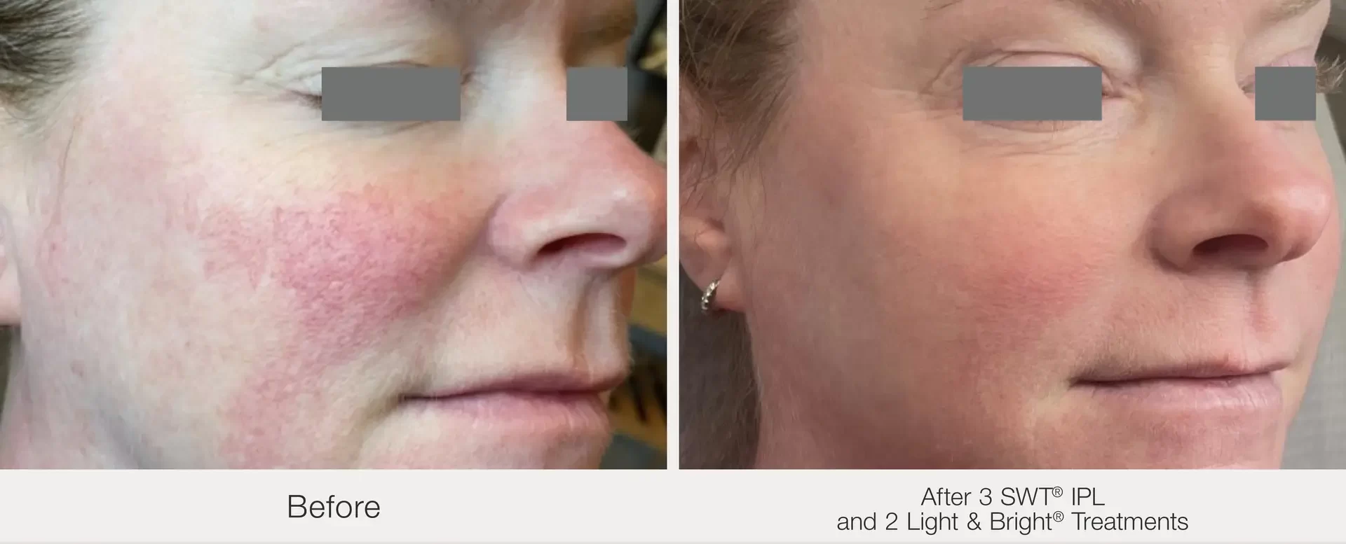 IPL | before and after | Advanced Care & Medspa | Lisle, IL