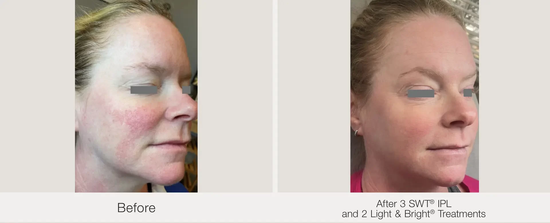 IPL treatment | before and after | Advanced Care & Medspa | Lisle, IL