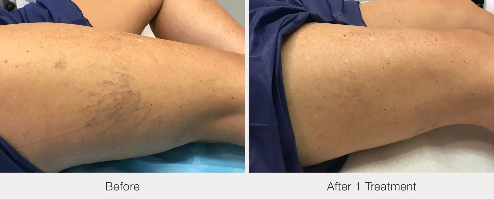 spider vein treatment | before and after | Advanced Care & Medspa | Lisle, IL