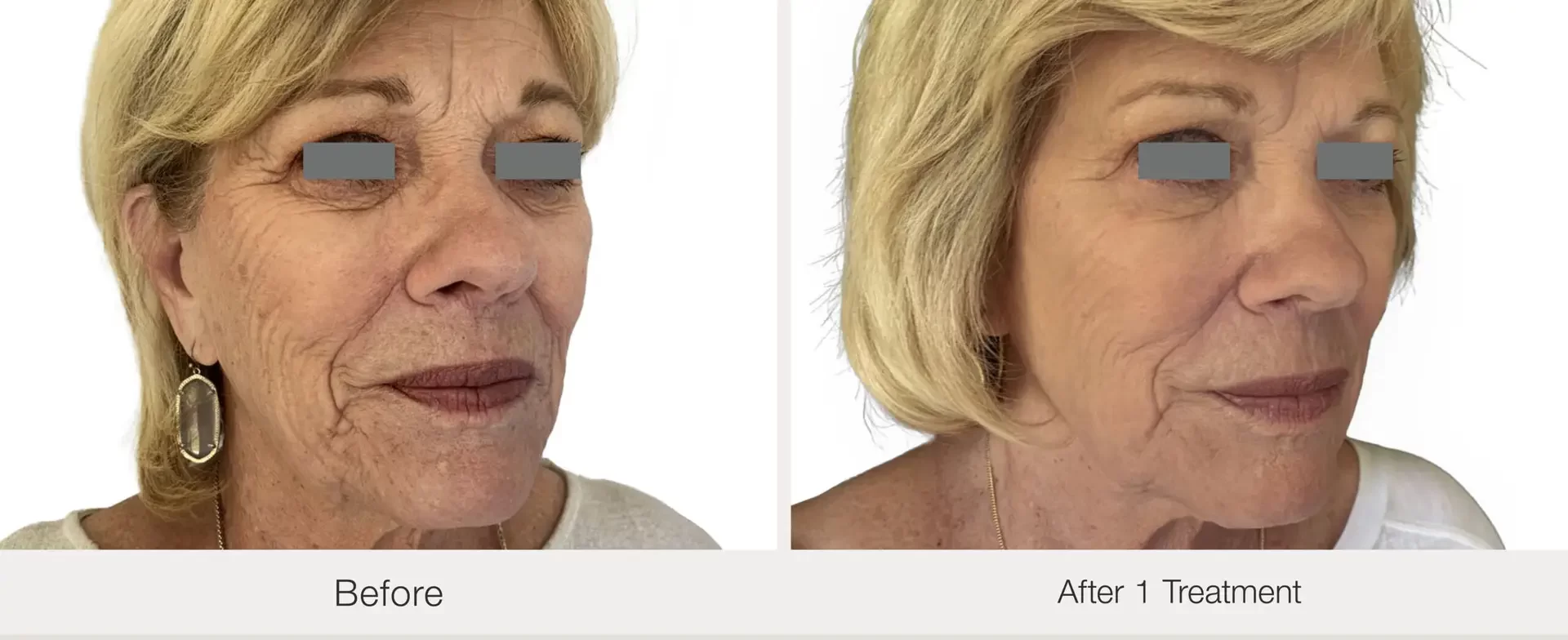 BA-Nordlys-MVergara | before and after | Advanced Care & Medspa | Lisle, IL