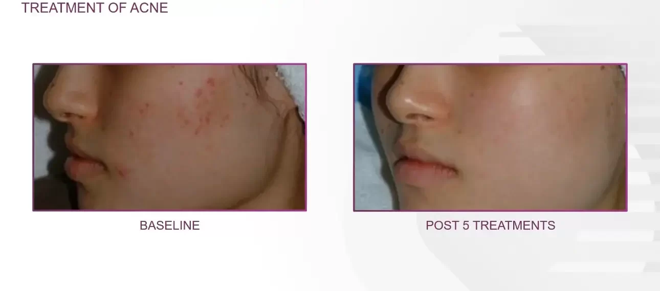 Acne of face | before and after | Advanced Care & Medspa | Lisle, IL