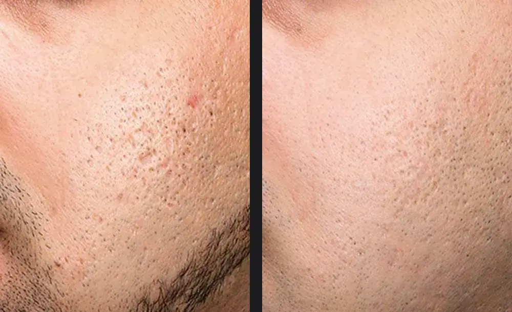 Exceed acne scars | before and after | Advanced Care & Medspa | Lisle, IL
