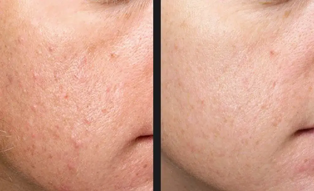 Exceed acne scars treatment | before and after | Advanced Care & Medspa | Lisle, IL