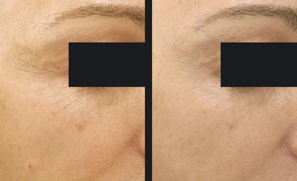 Crows feet | before and after | Advanced Care & Medspa | Lisle, IL
