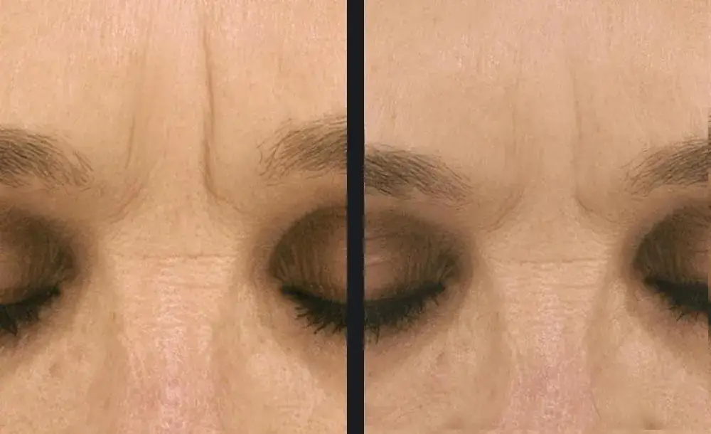 Frowns lines | before and after | Advanced Care & Medspa | Lisle, IL