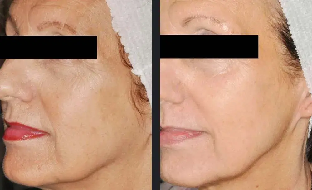 Skin rejuvenation | before and after | Advanced Care & Medspa | Lisle, IL