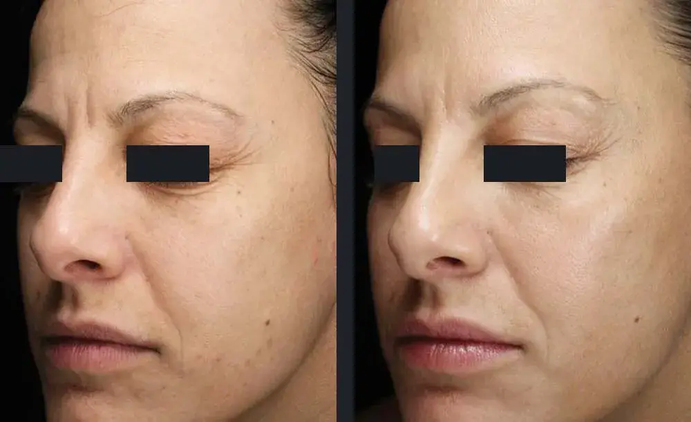 Frax Pro Skin rejuvenation | before and after | Advanced Care & Medspa | Lisle, IL