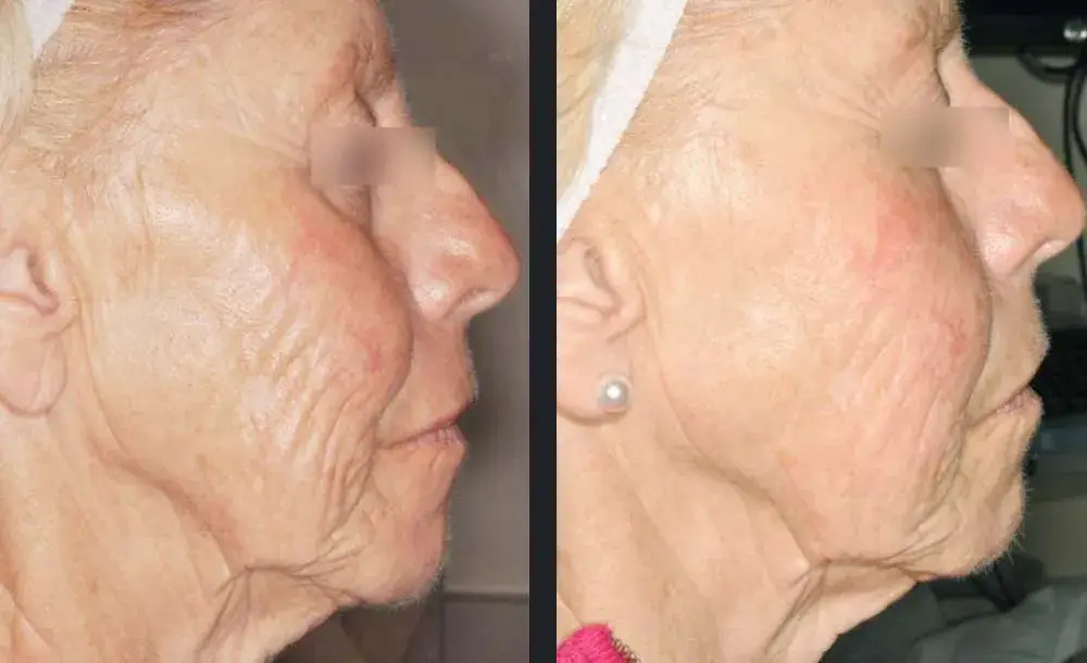 Skin resurfacing service | before and after | Advanced Care & Medspa | Lisle, IL
