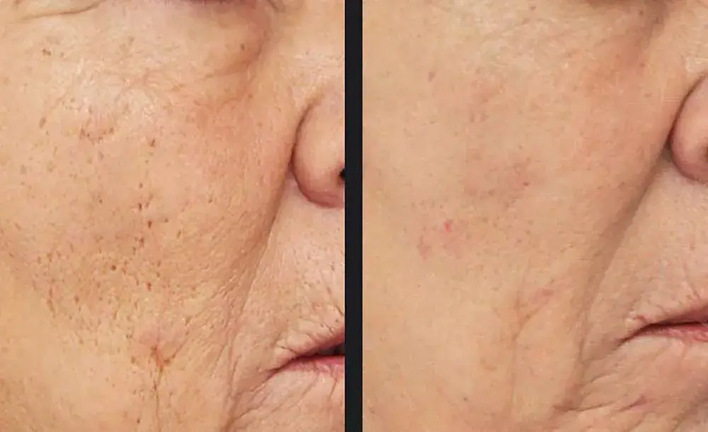 Pro skin resurfacing | before and after | Advanced Care & Medspa | Lisle, IL