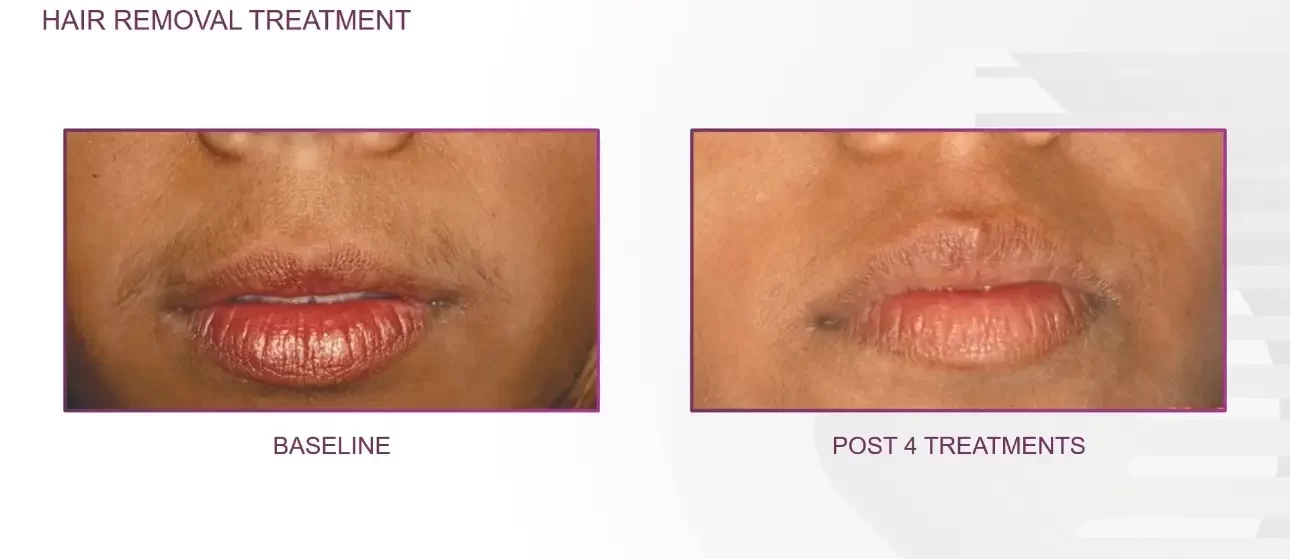 Hair removal above lips | before and after | Advanced Care & Medspa | Lisle, IL