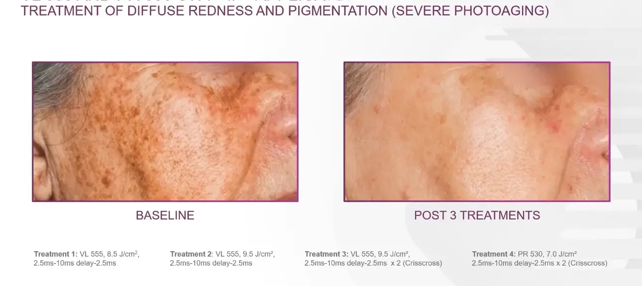 Redness and pigmentation | before and after | Advanced Care & Medspa | Lisle, IL