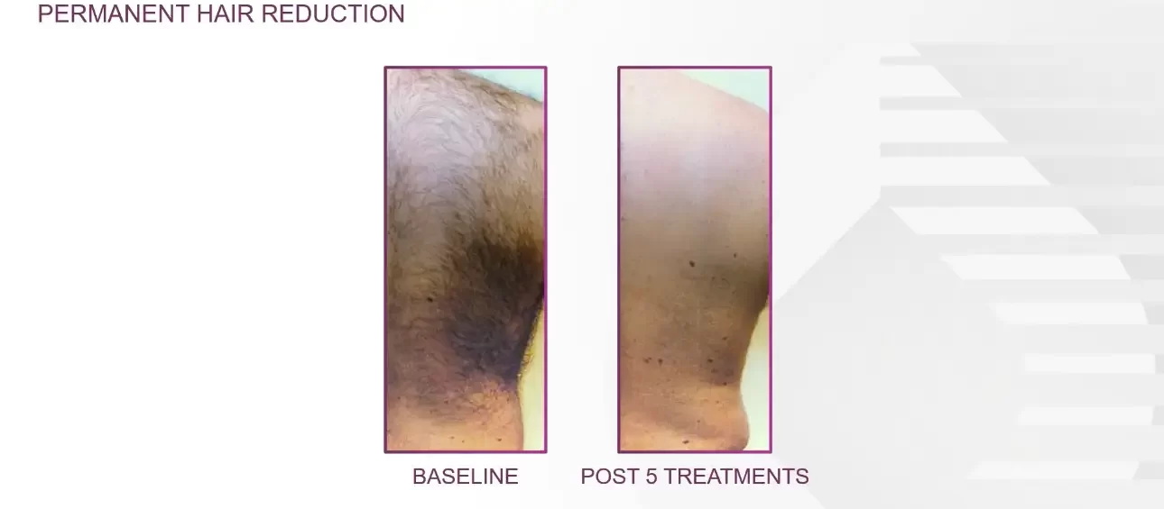 perm hair reduction | before and after | Advanced Care & Medspa | Lisle, IL