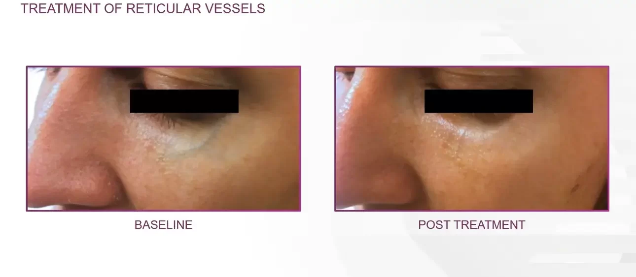 reticular vessels | before and after | Advanced Care & Medspa | Lisle, IL