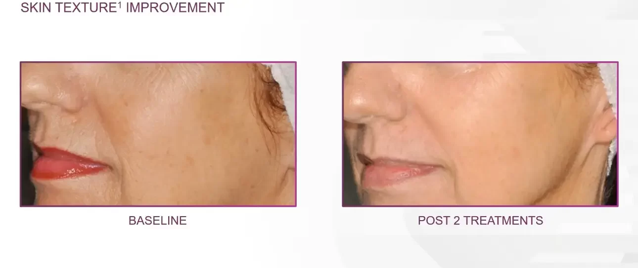 skin texture improvement | before and after | Advanced Care & Medspa | Lisle, IL