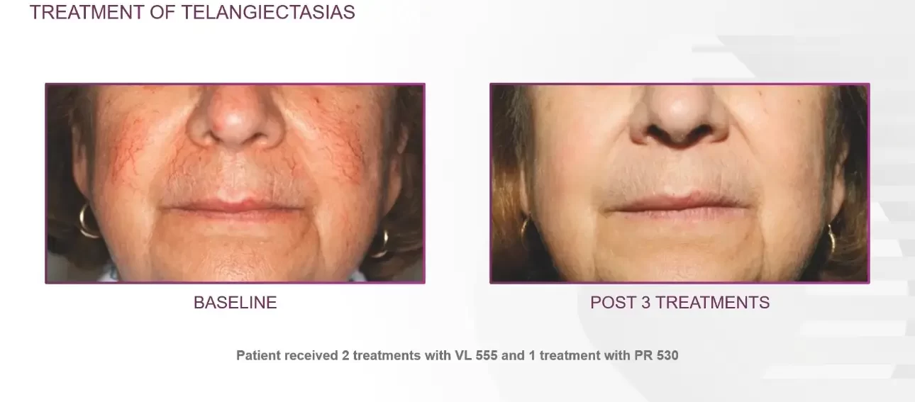 Telangiectasias | Advanced Care & Medspa | Lisle, IL