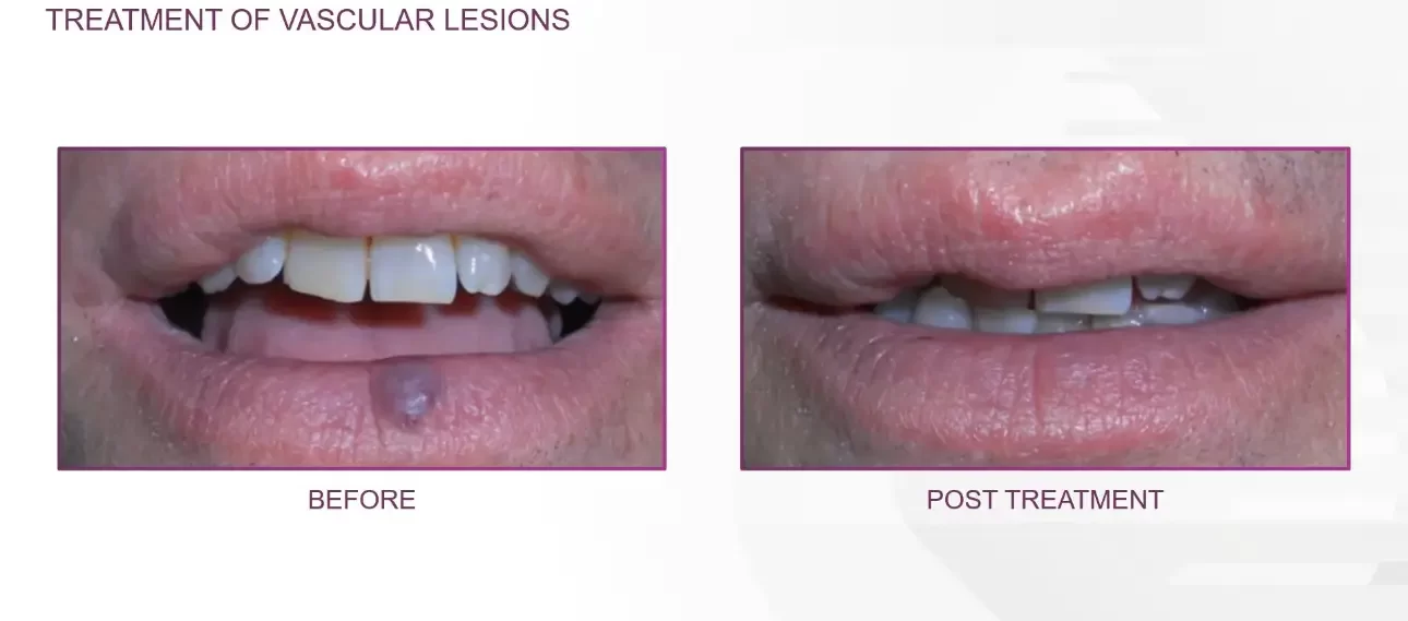 Vascular lesions | before and after | Advanced Care & Medspa | Lisle, IL
