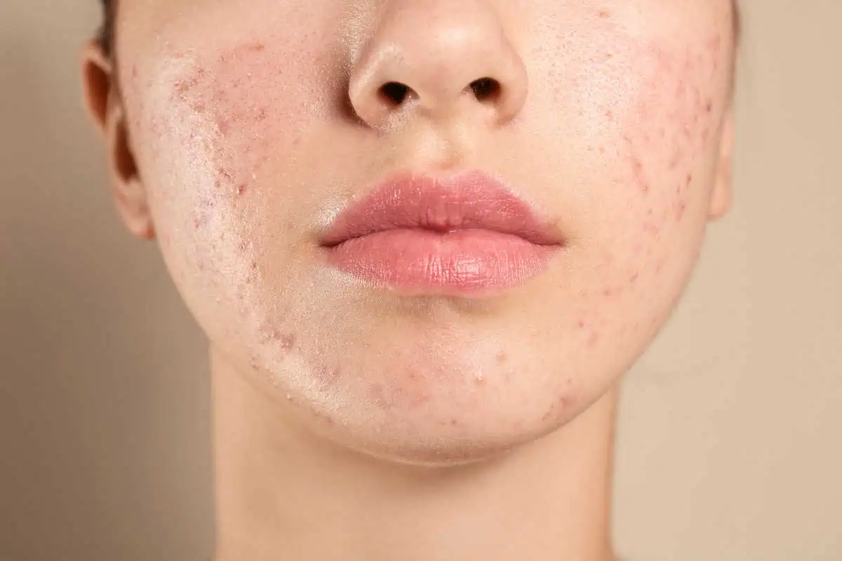 Acne treatment for face | Advanced Care & Medspa | Lisle, IL
