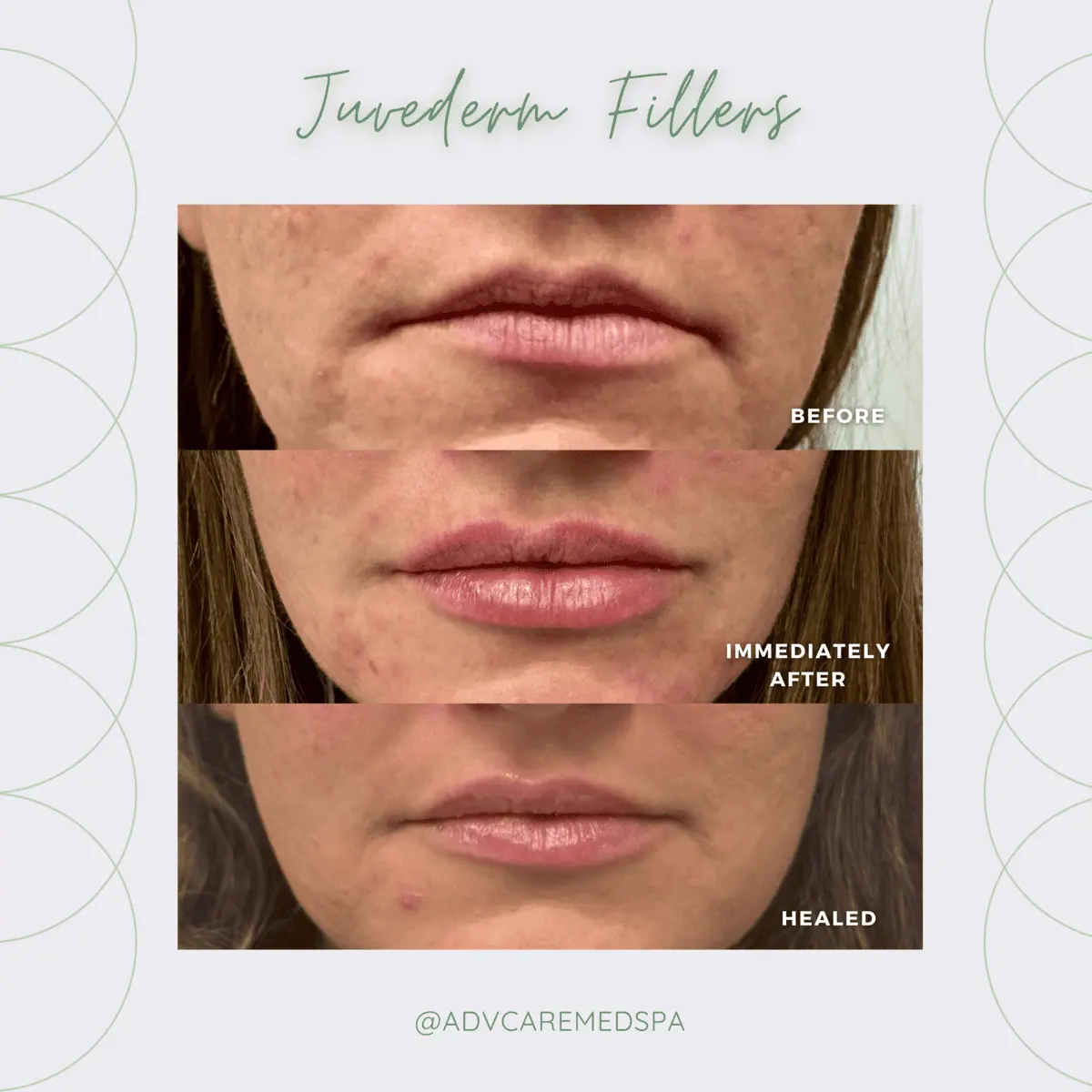 Juvederm filler before and after | Advanced Care & Medspa | Lisle, IL