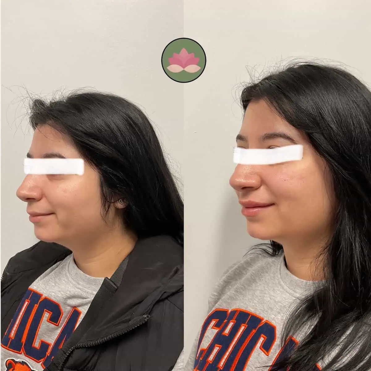 Skin rejuvenation before and after | Advanced Care & Medspa | Lisle, IL