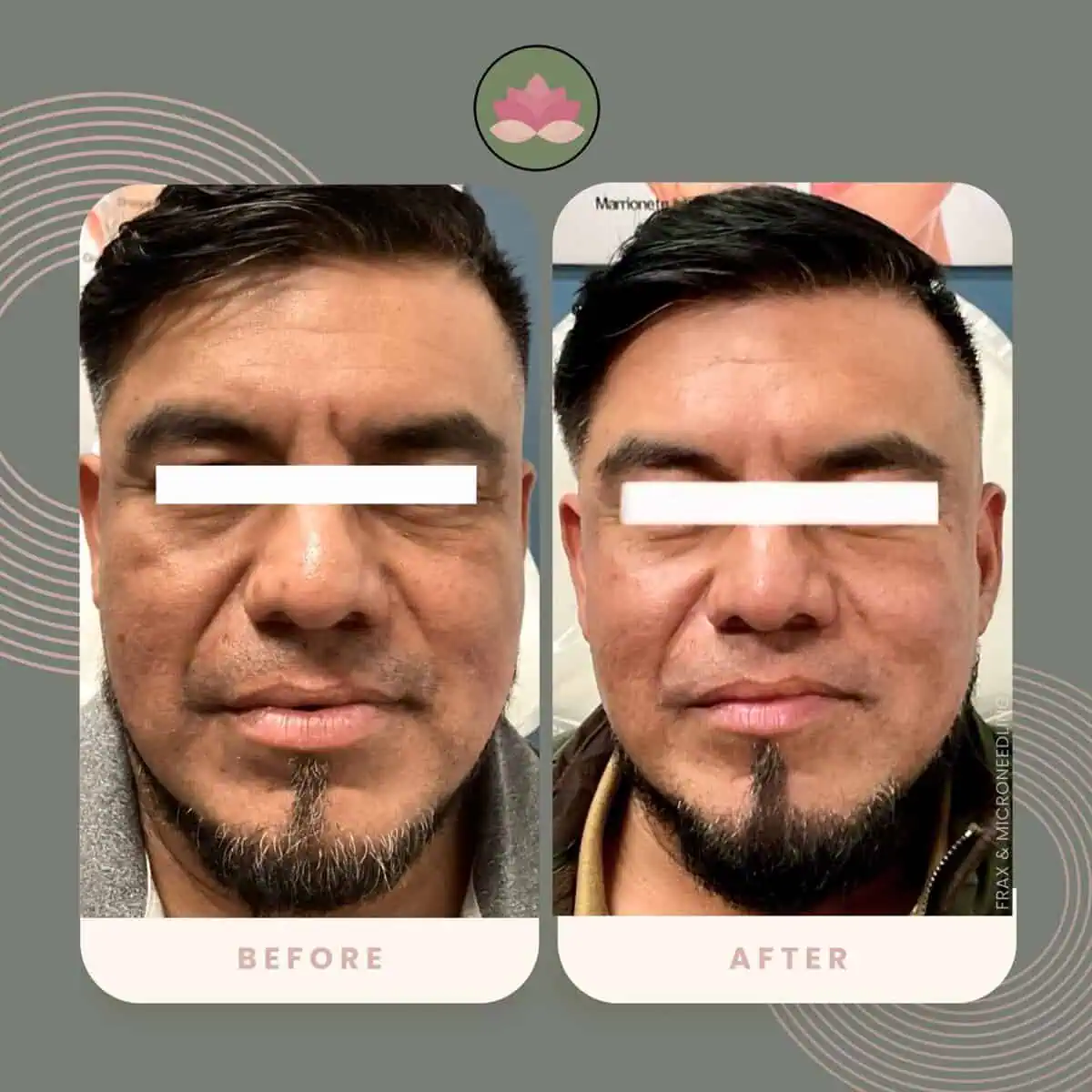 Facial rejuvenation before and after | Advanced Care & Medspa | Lisle, IL