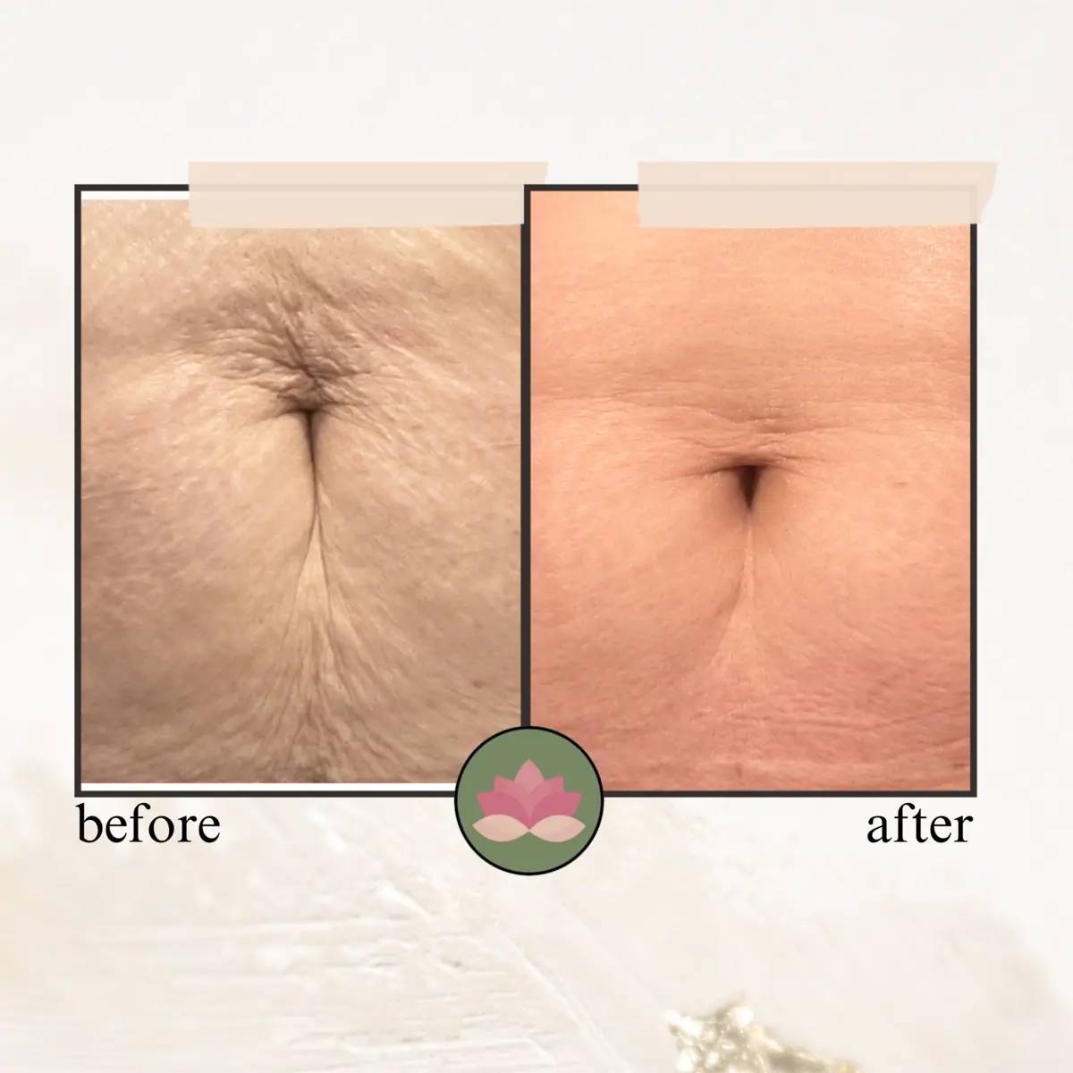 Skin tightening before and after | Advanced Care & Medspa | Lisle, IL