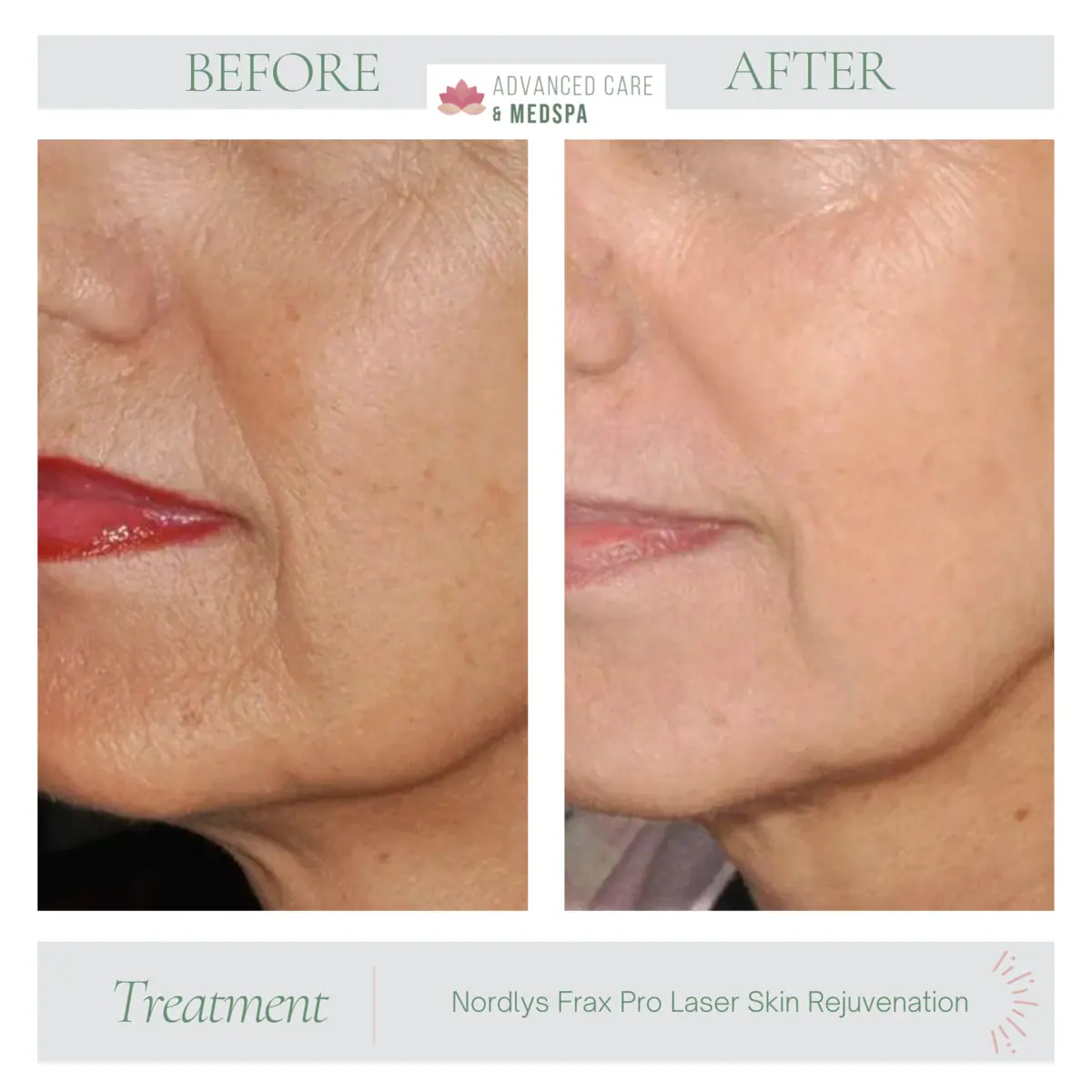 Facial lines before and after | Advanced Care & Medspa | Lisle, IL