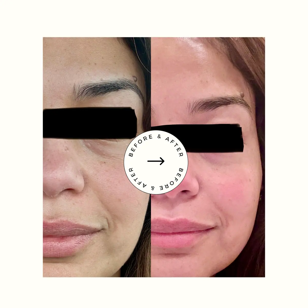 Wrinkles before and after photo | Advanced Care & Medspa | Lisle, IL