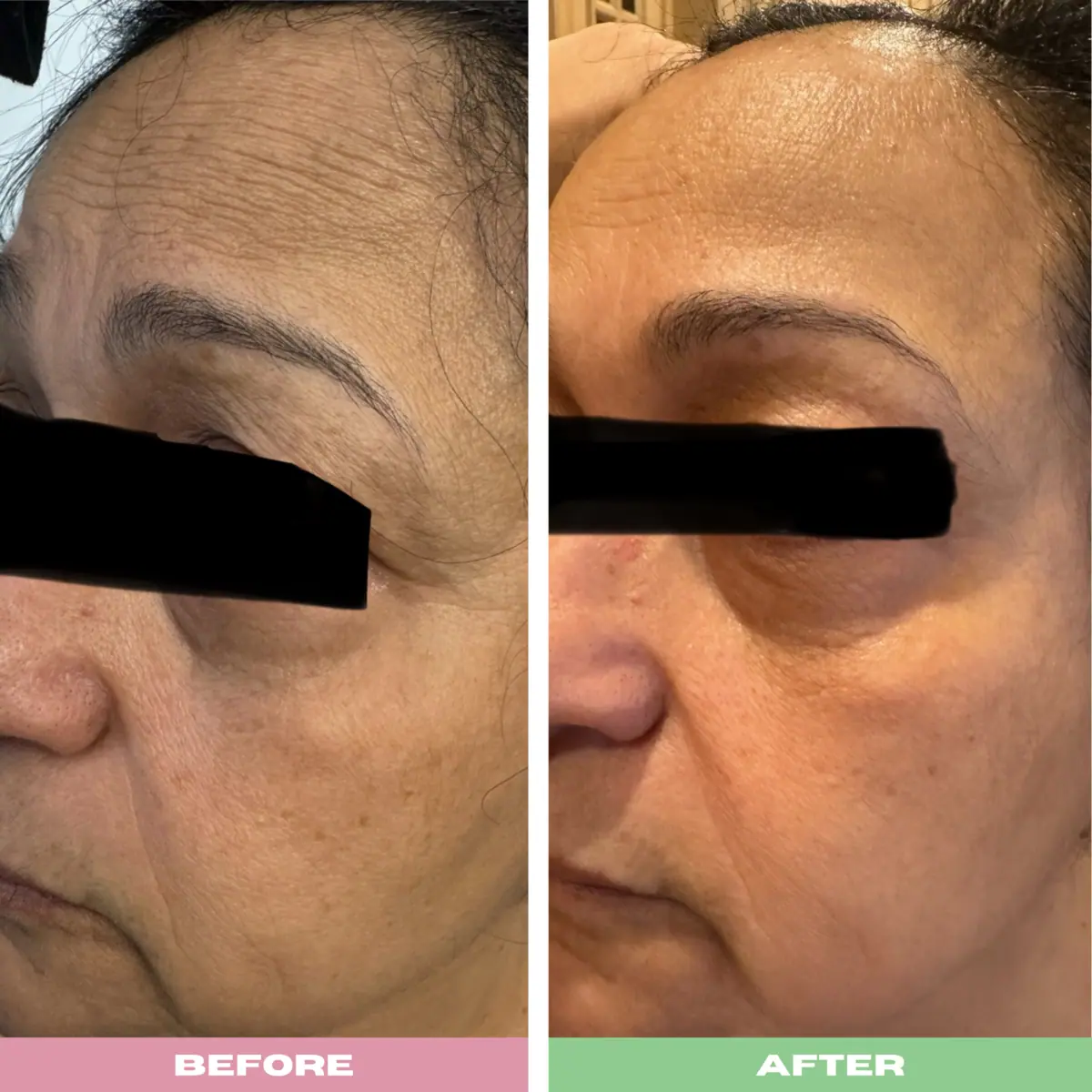 Before and After photo | woman undergone treatment | | Advanced Care & Medspa | Lisle, IL