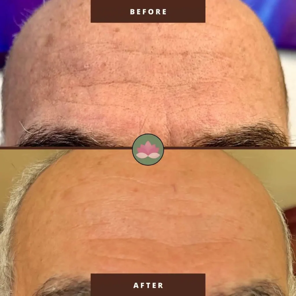 Before and After treatment photo | Advanced Care & Medspa | Lisle, IL