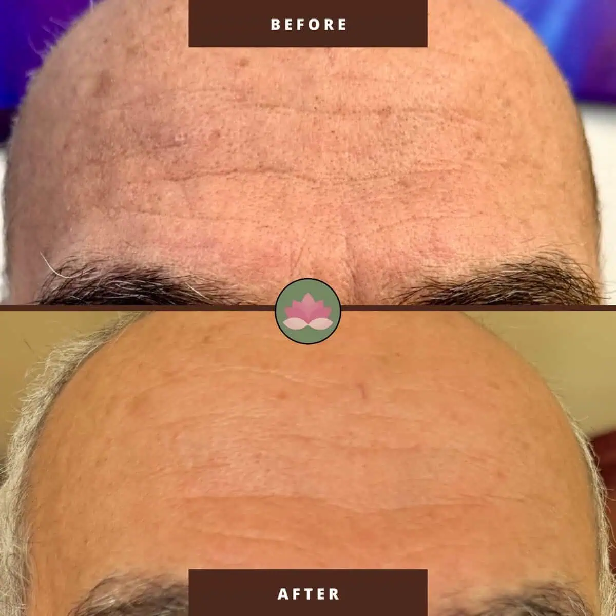 Before and After treatment photo | Advanced Care & Medspa | Lisle, IL
