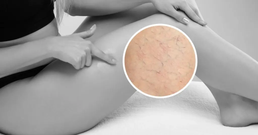 A patient receiving leg telangiectasia treatment to eliminate visible spider veins at Advanced Care & MedSpa.