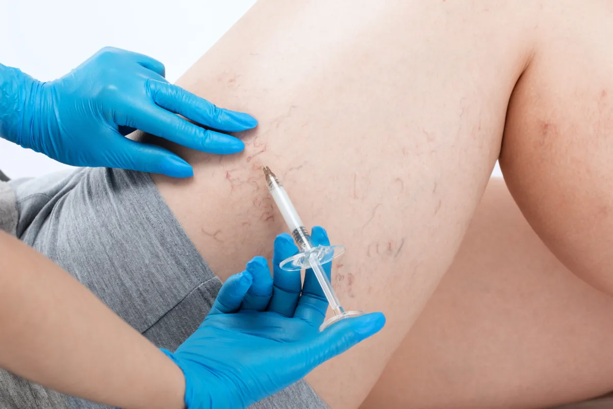 Woman receiving telangiectasia treatment on her cheeks with a specialized laser handpiece at Advanced Care & MedSpa